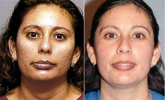 Chemical Peel before 575412