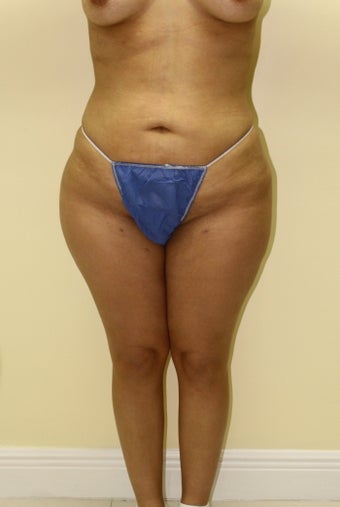 Brazilian butt lift after 360623
