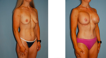 Tummy tuck, breast lift with implants, liposuction before 307053