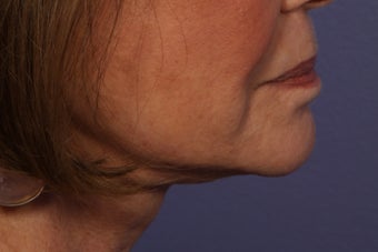 Botox to Neck (Platysmal Band Muscles) after 445465