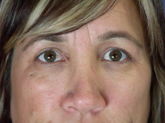 Eyelid Surgery after 306459