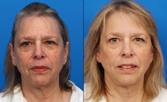 Ultherapy before 411577