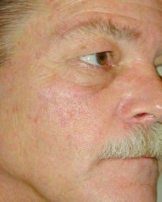 PDT for rosacea after 376139
