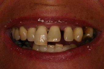 Same day implant supported teeth. before 350499