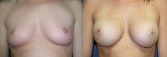 Breast Augmentation before 328463