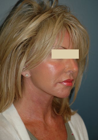 Facelift after 137049