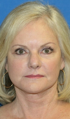 Short Incision Facelift and Lateral Browlift after 392431