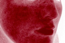 Laser Genesis for Overall Redness 326789