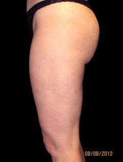 Cellulaze after 614469