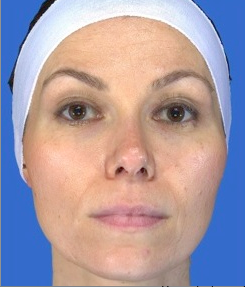 Chemical Peel before 469055
