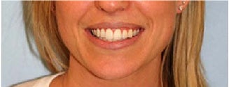 Invisalign after 109369