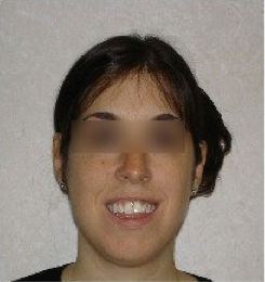 Invisalign Treatment 359168