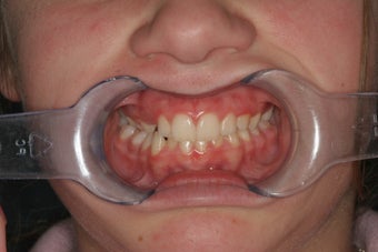 Upper Expander, Narrow Jaw, Impacted Canine before 296525