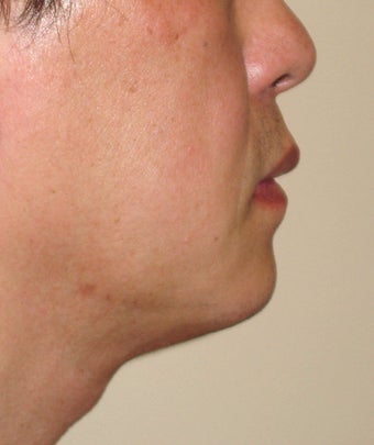 Chin Augmentation with Liposuction Neck after 365433