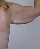 Arm Lift (Brachioplasty) before 142519