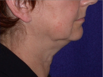 Necklift 208445
