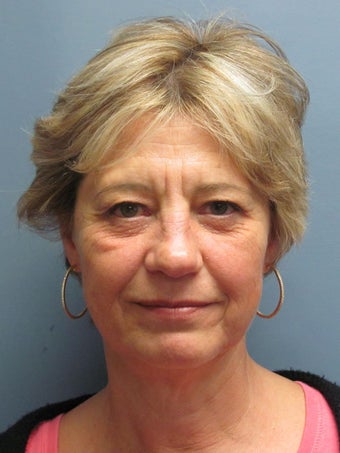 Brow Lift, Eyelid Lift before 519165