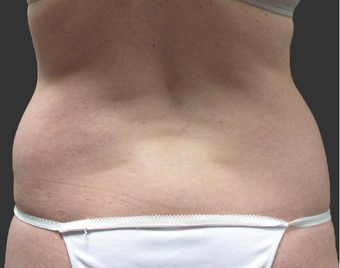Exilis before 423761