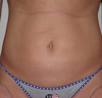 Liposuction after 313778