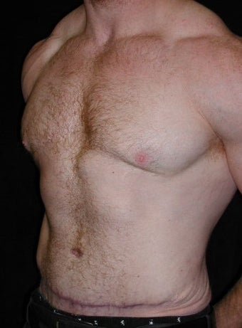 Male Tummy Tuck, Flank Liposuction, Male Breast Reduction 550017