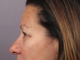 Eyelid Surgery before 306428