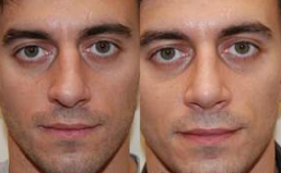 Rhinoplasty, 6 weeks post-op. before 150796