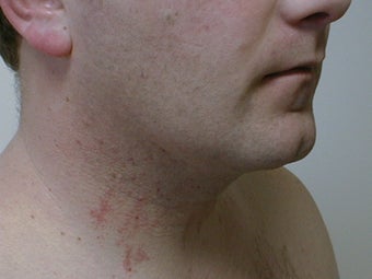 Liposuction of neck/chin area 590914