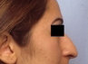 Rhinoplasty before 130765