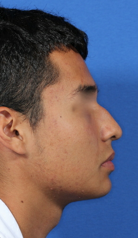 nasal airway surgery with cosmetic improvement 478799
