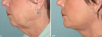 Chin Implant with Facelift before 342946