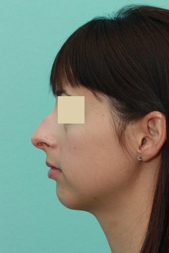 Open Septorhinoplasty before 134620