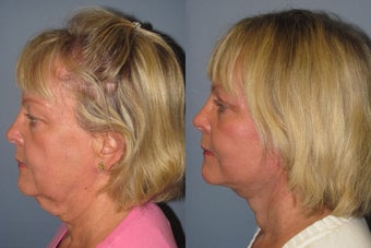 Lite Lift, Liposuction of the neck, eyelid lift before 523504