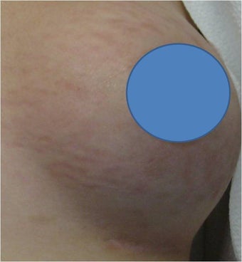 Vascular Laser for Red Stretch Marks of the breast after 82436