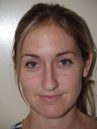 Rhinoplasty before 208155