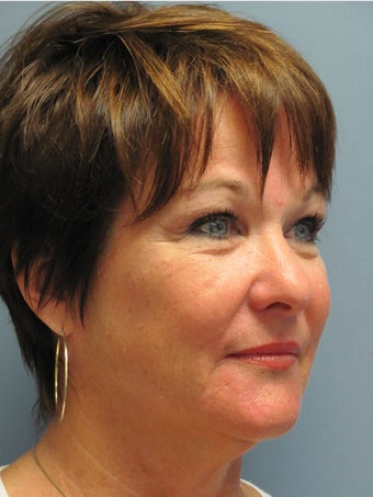 Chin Augmentation 635125
