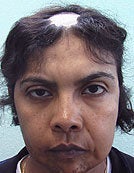 FUE – SFET Using Only Head Hair for Treatment of Lupus before 195672