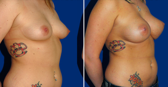 Breast Implants after 494494