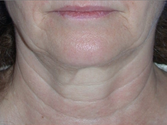 Necklift before 208447