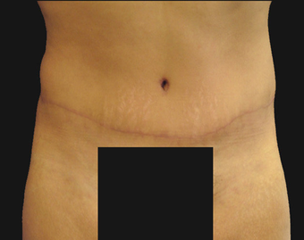 Abdominoplasty after 458932