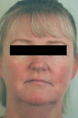 Rosacea and Facial Spider Veins after 106541