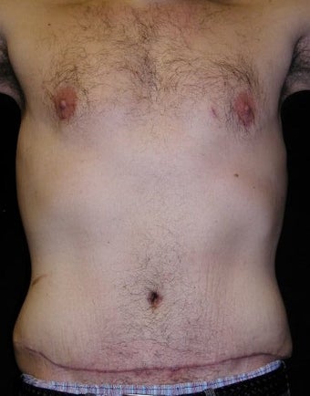 Male tummy Tuck, Flank Liposuction, Male Breast Reduction after 578158