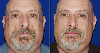 Sculptra before 496293