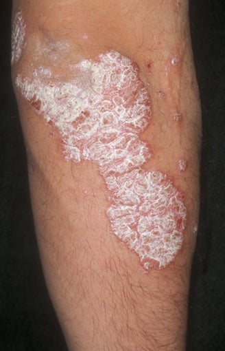 Psoriasis Treatment before 359385