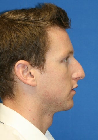 Rhinoplasty before 223264