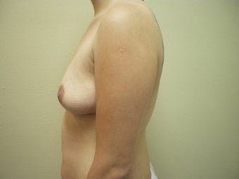 Breast Augmentation before 143441