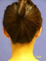 Ear Surgery (Otoplasty) after 357653