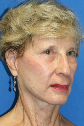Short Incision face lift and chemical peel after 223339