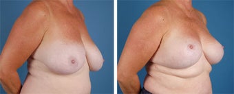 Breast Lift 355777