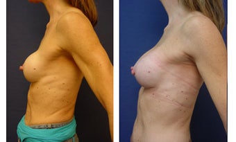 Breast implant correction 399965