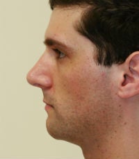 Rhinoplasty revision before 380423